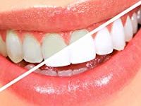 Teeth Whitening in Denver