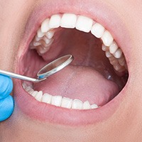 Teeth Bonding in Denver