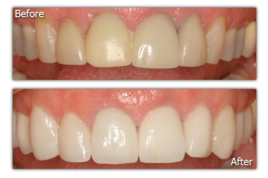 Dental Replacements - Patient 5