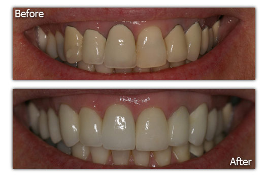 Dental Replacements - Patient 6