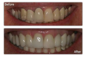 Dental Veneers - Before and After - Patient 5
