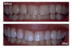 Dental Veneers - Before and After - Patient 2
