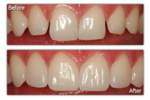 Dental Veneers - Before and After - Patient 6