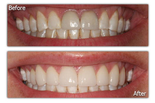 Dental Replacements - Patient 2