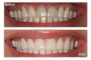 Dental Veneers - Before and After - Patient 4