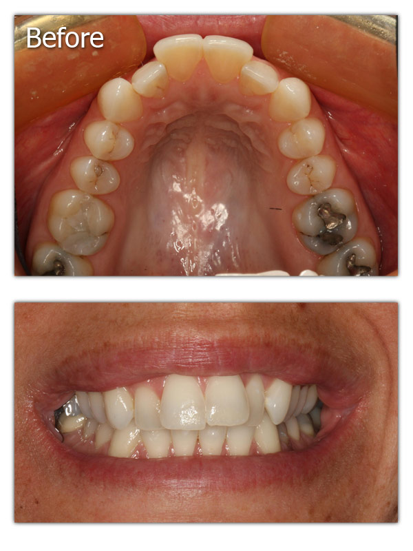 Orthodontics - Before