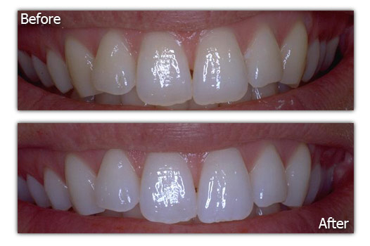 Teeth Whitening Patient 2