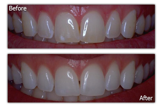 Teeth Whitening Patient 3