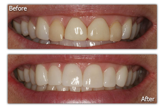Dental Replacements - Patient 1