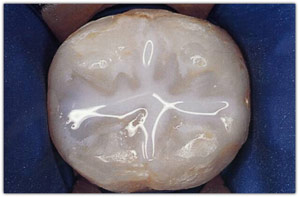 Sample Dental Sealant