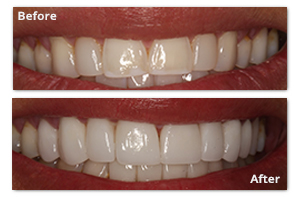 Dental Veneers - Before and After - Patient 3