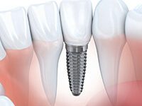 Dental Implants in Denver, CO | Downtown Denver Dentist