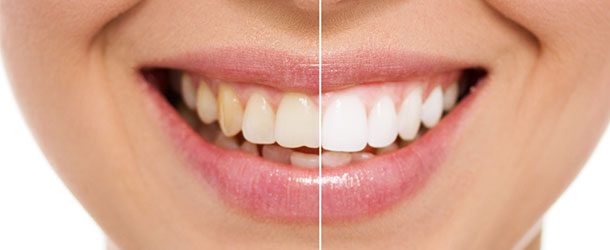 Smile Makeover Service in Denver